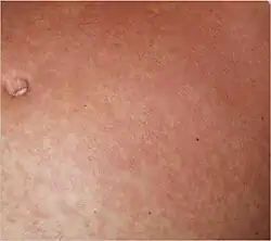 Typical fine-spotted pink rash of acute African trypanosomiasis on the skin of the abdomen ("trypanid rash")[15]