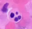 Microscopy of an apoptotic neutrophil with nuclear fragmentation (H&E stain)