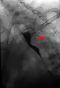 Aberrant subclavian artery seen at swallowing study: impression of the esophagus from behind.