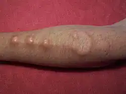 Subdermal implant