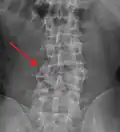 A burst fracture of L4 as seen on plane X ray