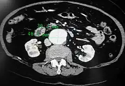 An axial contrast-enhanced CT scan demonstrating an abdominal aortic aneurysm of 4.8 by 3.8 cm