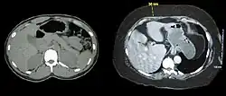 Two computed tomography images of a horizontal section of the mid abdominal region; one from a normal weight individual the other from an obese person. In both the bony structures and organs appear similar. The primary difference is that in the normal weight person there is little subcutaneous fat and the obese person shows substantially subcutaneous fat.