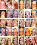 Healing of frenuloplasty