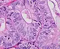 Nuclear grade 1: Oval, mildly enlarged nucleus with evenly distributed chromatin.[63]