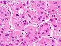 Moderately differentiated HCC