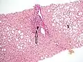 Histopathology of steatohepatitis with mild fibrosis in the form of fibrous expansion (Van Gieson's stain)[97]
