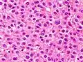 Well-differentiated HCC