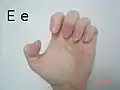 A 'claw' hand; thumb does not touch fingers