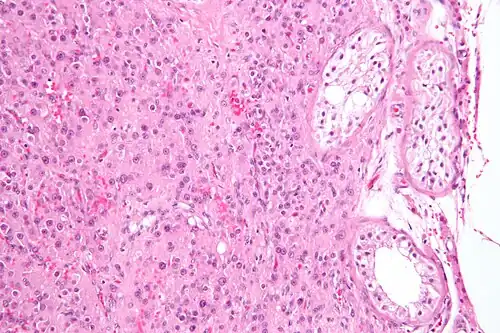 Micrograph of a Leydig cell tumour
