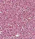Undifferentiated nasopharyngeal carcinoma—high power