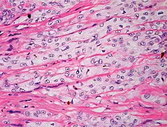 Poorly differentiated, where attempts at keratinization are often no longer evident. This is a clear-cell squamous-cell carcinoma. The dysplastic cells infiltrated cords through the dermis. Poorly differentiated cSCC has greatly enlarged pleomorphic nuclei showing a high degree of atypia and frequent mitoses.[12]