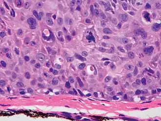 cSCC in situ, high magnification, demonstrating an intact basement membrane.[12]