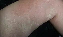Nevus anemicus