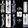 Normal whole body PET/CT scan with FDG-18. The whole body PET/CT scan is commonly used in the detection, staging and follow-up of various cancers.
