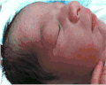 Petechiae on face due to tight nuchal cord