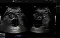 Renal cyst as seen on abdominal ultrasound