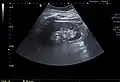 A very small (8 mm) simple renal cyst.