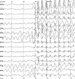 The electroencephalogram recording of a person with childhood absence epilepsy showing a seizure. The waves are black on a white background.