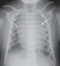 A prominent thymus, which can give the impression of a widened mediastinum.[10]