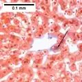 NASH (inflammation) and fibrosis stage 1